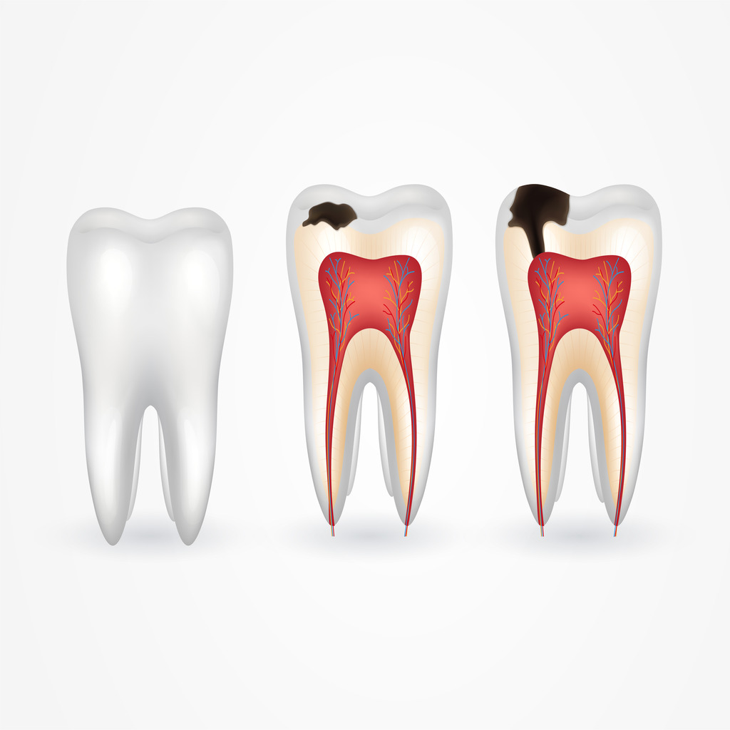 Management of Deep Caries